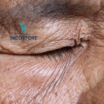 Flacidez facial e corporal: causas, prevenção e tratamentos eficazes