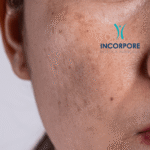 Manchas na pele: o que causa, como prevenir e quais tratamentos realmente funcionam