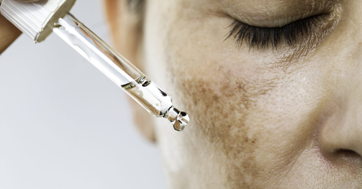 Hyperpigmentation Unrecognizable female suffering from hyperpigmentation (melasma) is about to use face serum for skin brightening.
She has dark spots on her face and her eyes are closed.