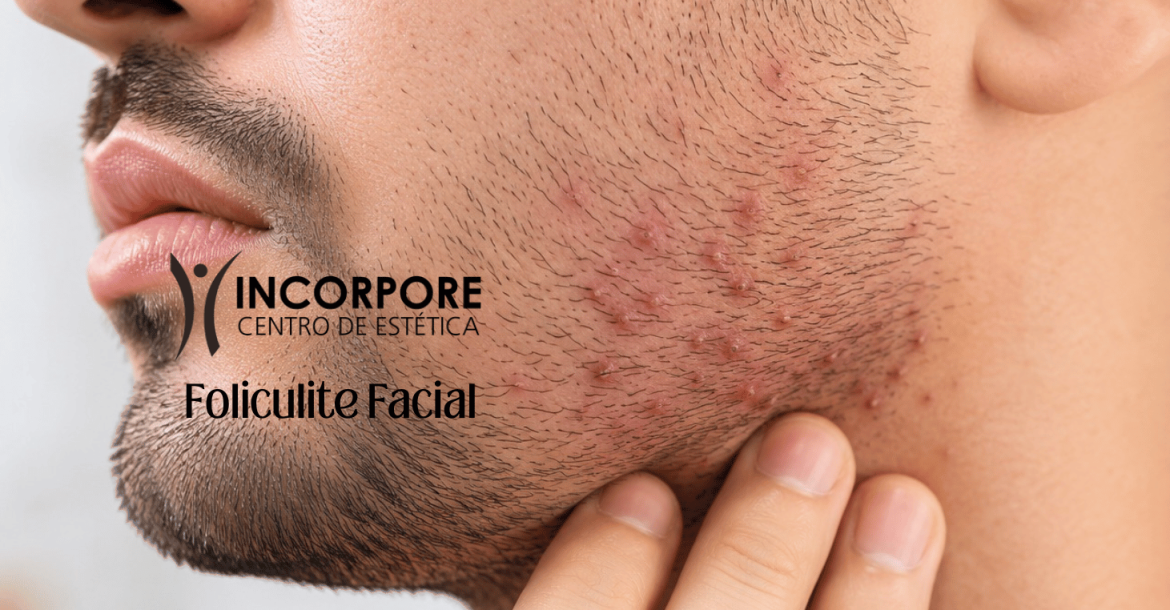 HEADER Foliculite Facial SITE NOVO 2 2025 (1461 x 1174 px)