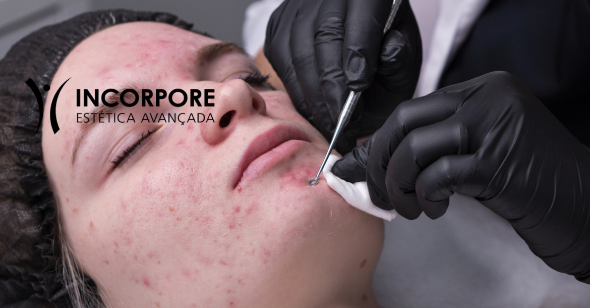HEADER Limpeza de Pele Avançada acne SITE NOVO 2025 (1461 x 1174 px) HEADER Limpeza de Pele Avançada acne SITE NOVO 2025 (1461 x 1174 px)