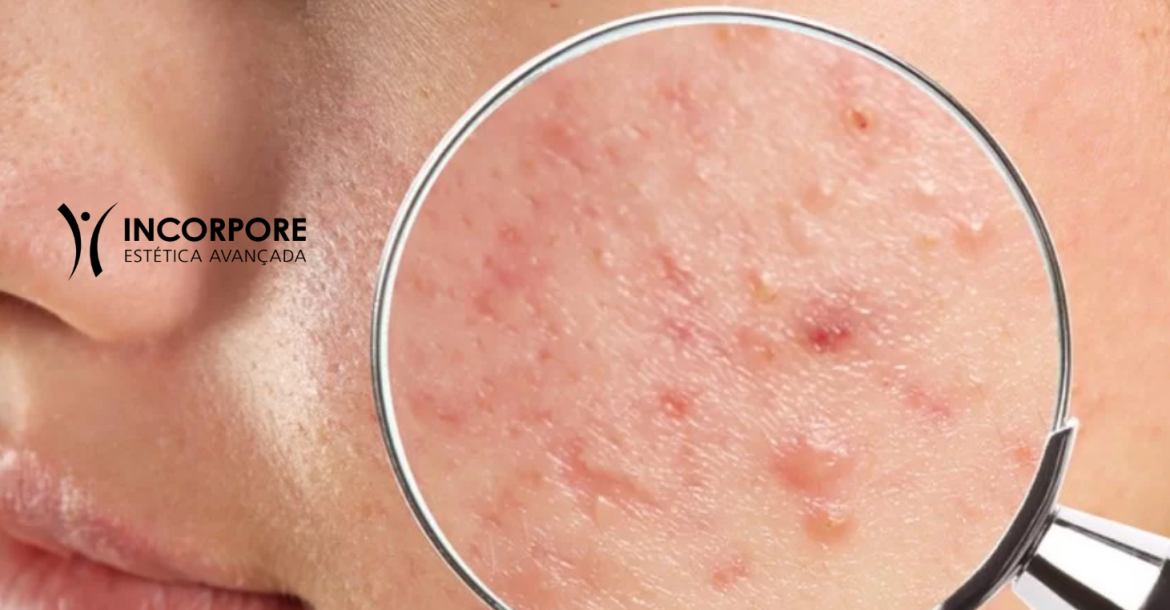 HEADER tratamento acne SITE NOVO 2025 (1461 x 1174 px) HEADER tratamento acne SITE NOVO 2025 (1461 x 1174 px)