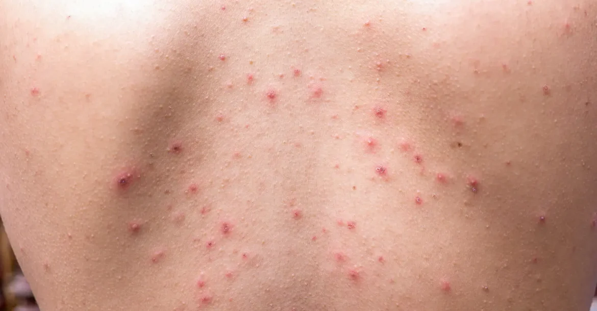 Detail with chicken pox rash at the back of body Detail with chicken pox rash at the back of body